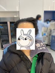 体验后-大麦微针植发全国连锁