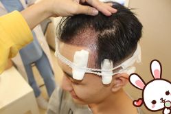 -大麦微针植发丨全国连锁