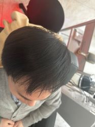 点击看大图 体验后-大麦微针植发丨全国连锁