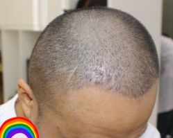 -大麦微针植发丨全国连锁