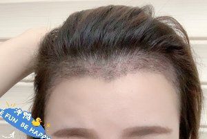 -大麦微针植发丨全国连锁