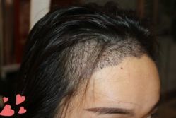 -大麦微针植发丨全国连锁