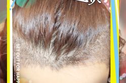 -大麦微针植发全国连锁