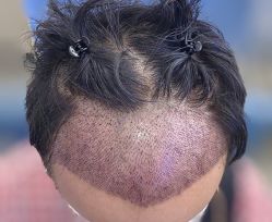 -大麦微针植发全国连锁