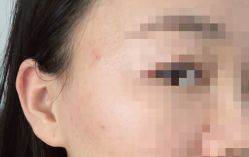 体验后-亿美医疗美容·半岛大超炮官方授权店