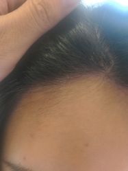 -碧莲盛·不剃发植发