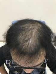-大麦微针植发丨全国连锁