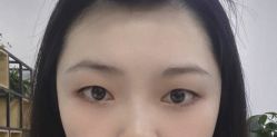 体验前-成都西区医院整形美容