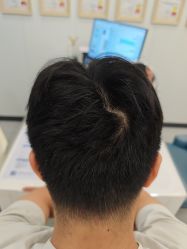 -大麦微针植发全国连锁