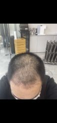 体验后-大麦微针植发丨全国连锁