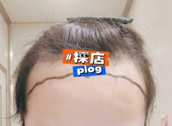 -大麦微针植发全国连锁