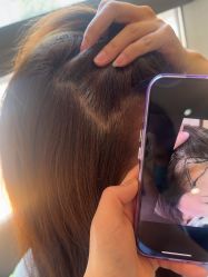 -碧莲盛·不剃发植发