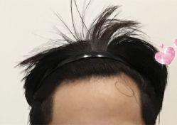 -大麦微针植发全国连锁