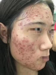 -瑶芳清颜草本祛痘