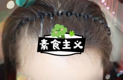 -大麦微针植发全国连锁