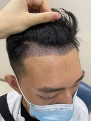 -大麦微针植发丨全国连锁