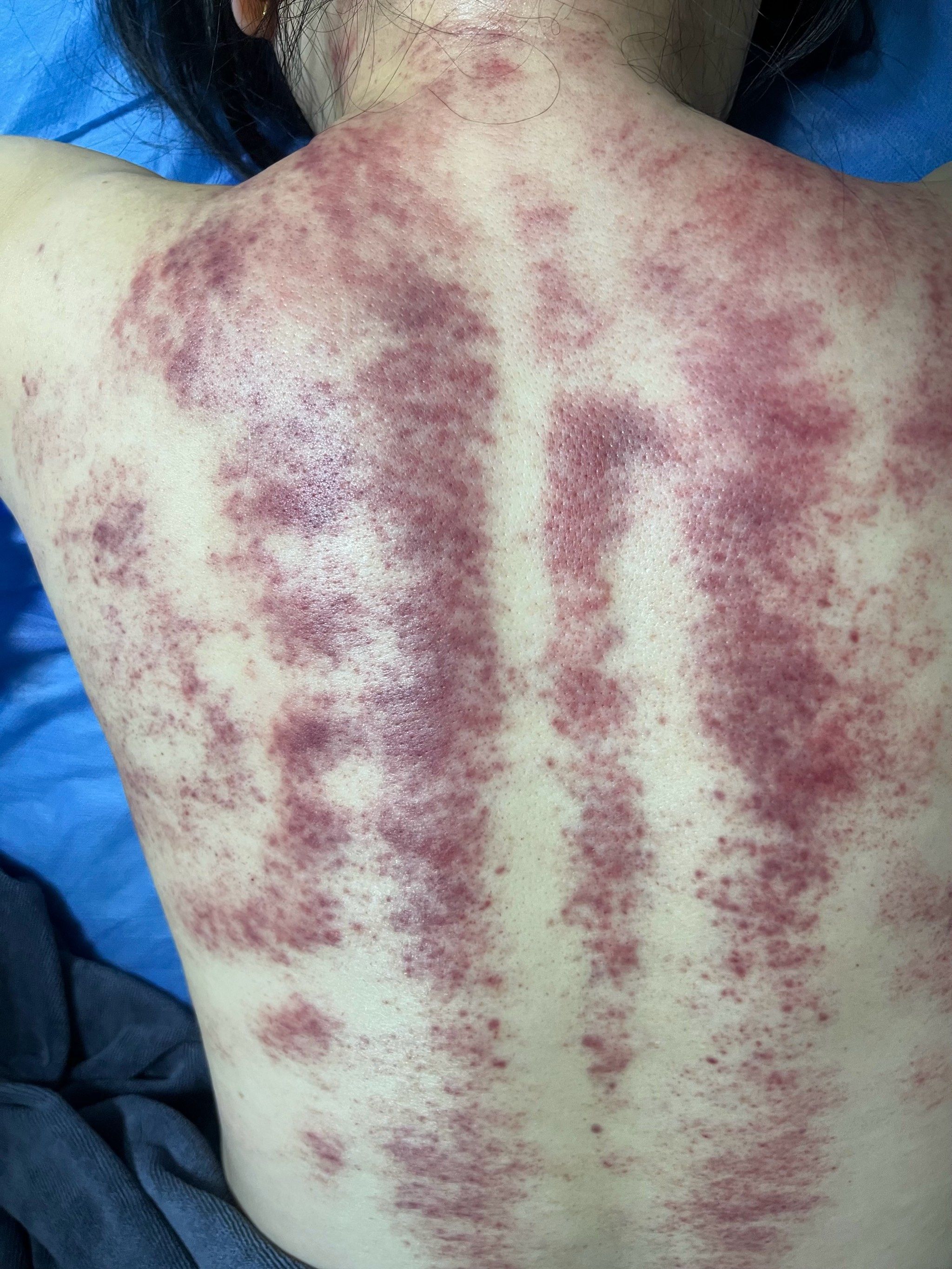 艾灸刮痧的成果