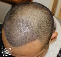 -大麦微针植发丨全国连锁