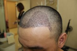 -大麦微针植发丨全国连锁