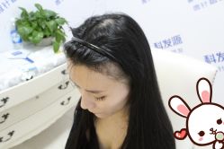 点击看大图 -大麦微针植发丨全国连锁