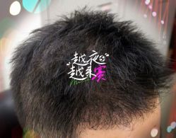 -大麦微针植发全国连锁