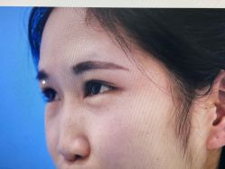 体验前-西安壹加壹医疗美容·西北抗衰旗舰店