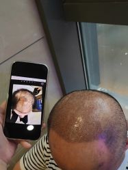 -碧莲盛·不剃发植发