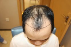 -大麦微针植发丨全国连锁