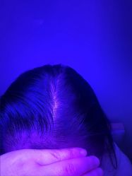 -大麦微针植发丨全国连锁