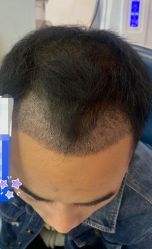 -大麦微针植发丨全国连锁