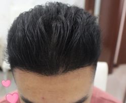 -大麦微针植发丨全国连锁