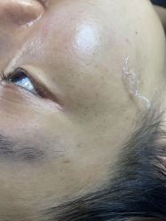 体验前-爱莎扁平疣·汗管瘤·斑痣中心