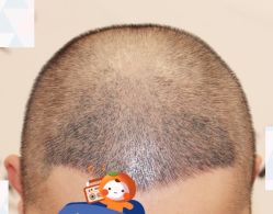 -大麦微针植发全国连锁