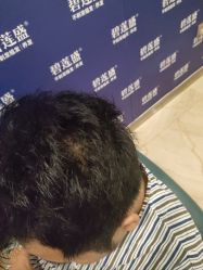 -碧莲盛·不剃发植发