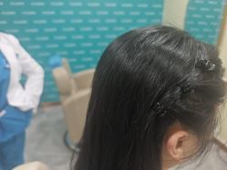 -碧莲盛·不剃发植发