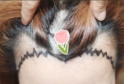 -大麦微针植发全国连锁