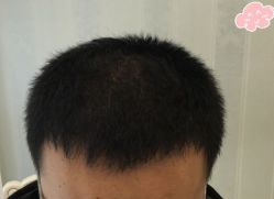 -大麦微针植发丨全国连锁