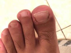 -世龙世家灰指甲鸡眼脚气甲沟炎跖疣护理(通州店)