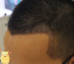 -大麦微针植发丨全国连锁