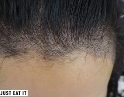 -大麦微针植发丨全国连锁