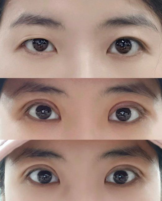 割双眼皮前后对比