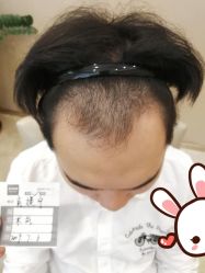 点击看大图 -大麦微针植发丨全国连锁