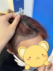 -大麦微针植发全国连锁