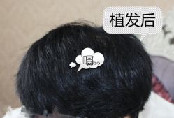 -大麦微针植发全国连锁