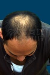 增发前-髻尚坊增发补发织发假发定制