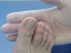 -Andrew指甲专科灰指甲·甲沟炎矫正·3D步态矫形鞋垫定制(浦三路店)