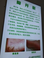 -德哥灰指甲脚气甲沟炎跖疣护理