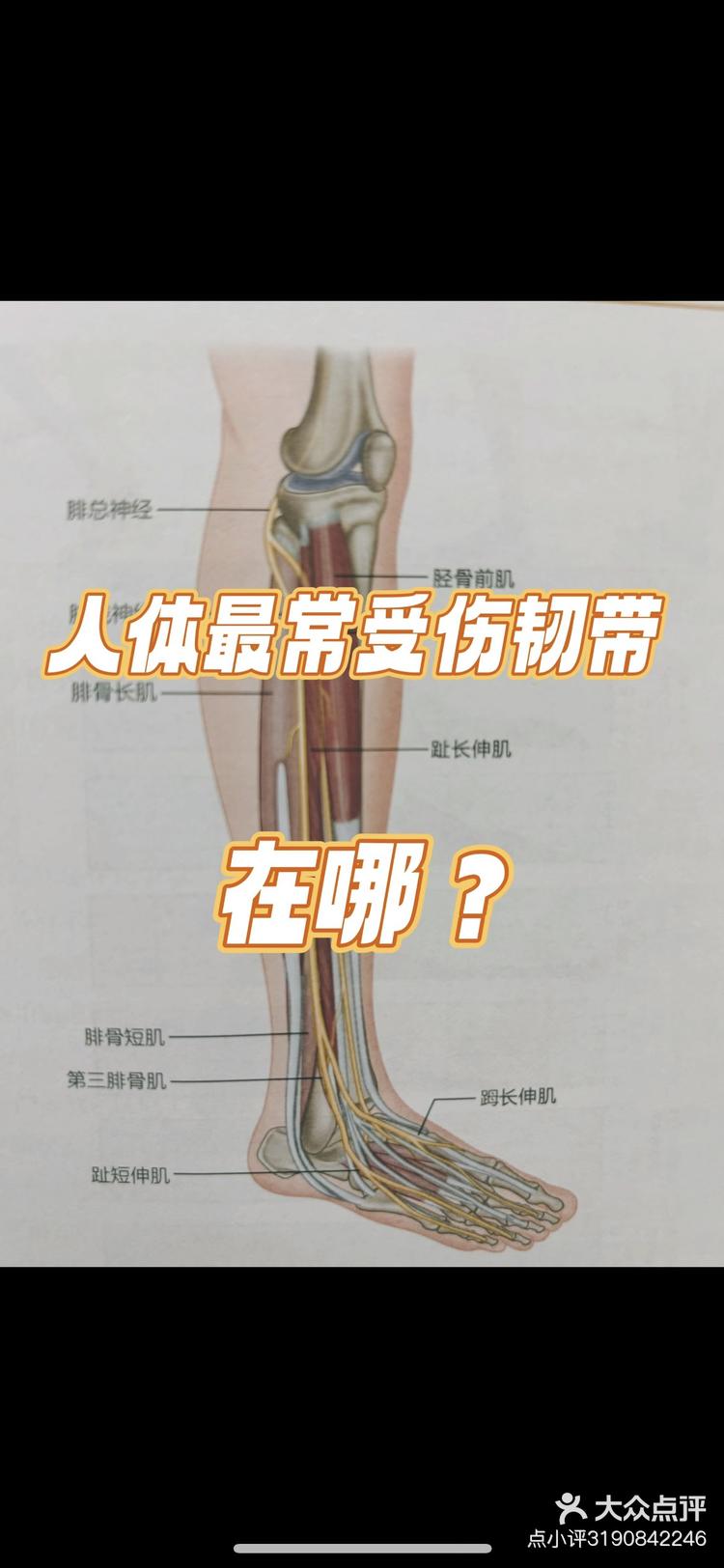 距腓前韧带为人体最容易受伤的韧带,受第三