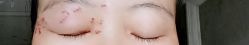 -爱莎扁平疣·汗管瘤·斑痣中心