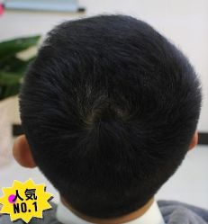 -大麦微针植发丨全国连锁